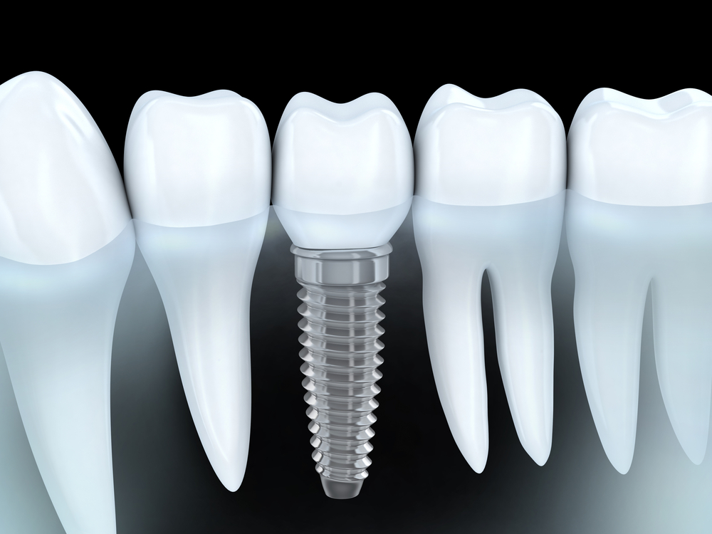 Implant dentaire à Casablanca : étapes, durée et prix